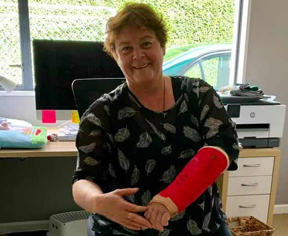 Chandra shows off her broken wrist in its bright red cast.